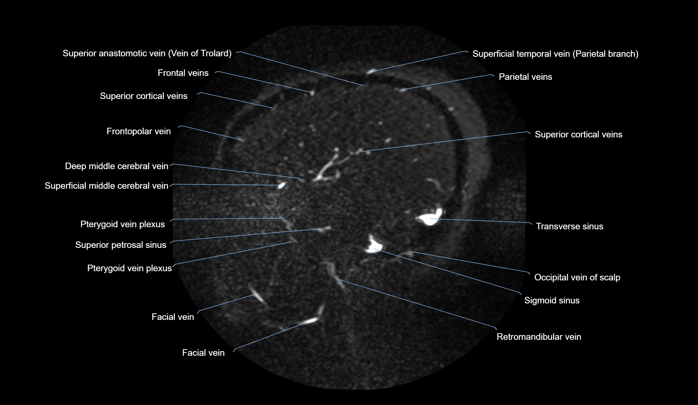MRV brain sagittal anatomy 3T MRI images -img-01015-00022.webp